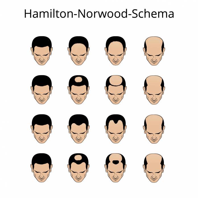 Hamilton-Norwood-Schema beim Haarausfall