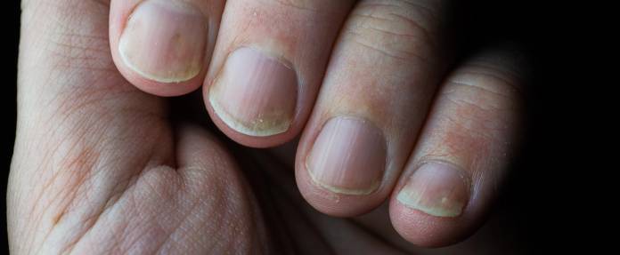 Nagelpsoriasis