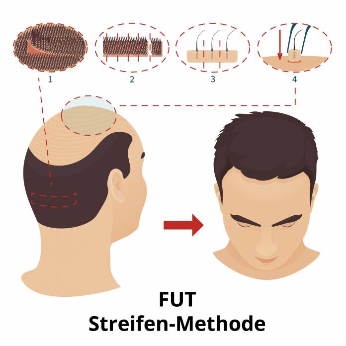 FUT-Methode