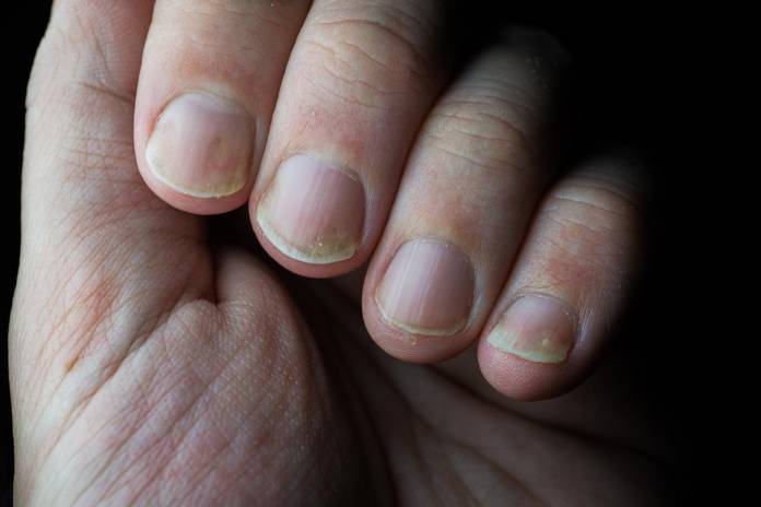 Weiße Flecken auf Fingernägel: Woher kommen sie und was hilft?