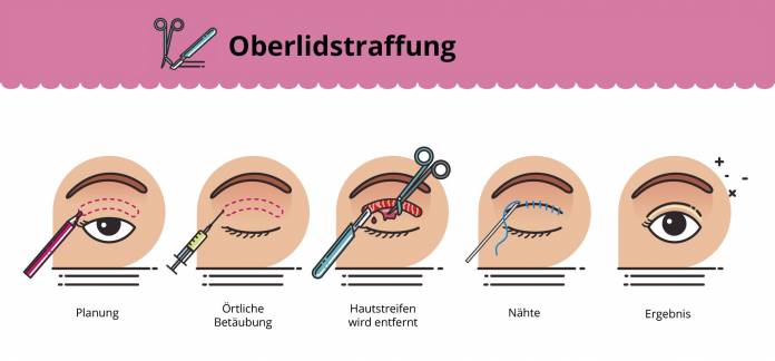 Oberlidstarffung