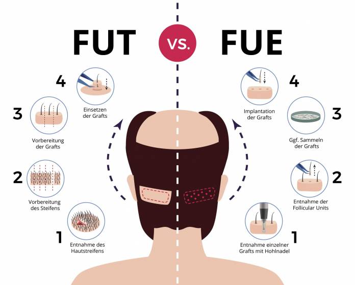 Unterschied zwischen der FUT und FUE-Methode